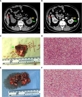 Single-Cell RNA-seq Identification of the Cellular Molecular Characteristics of Sporadic Bilateral Clear Cell Renal Cell Carcinoma